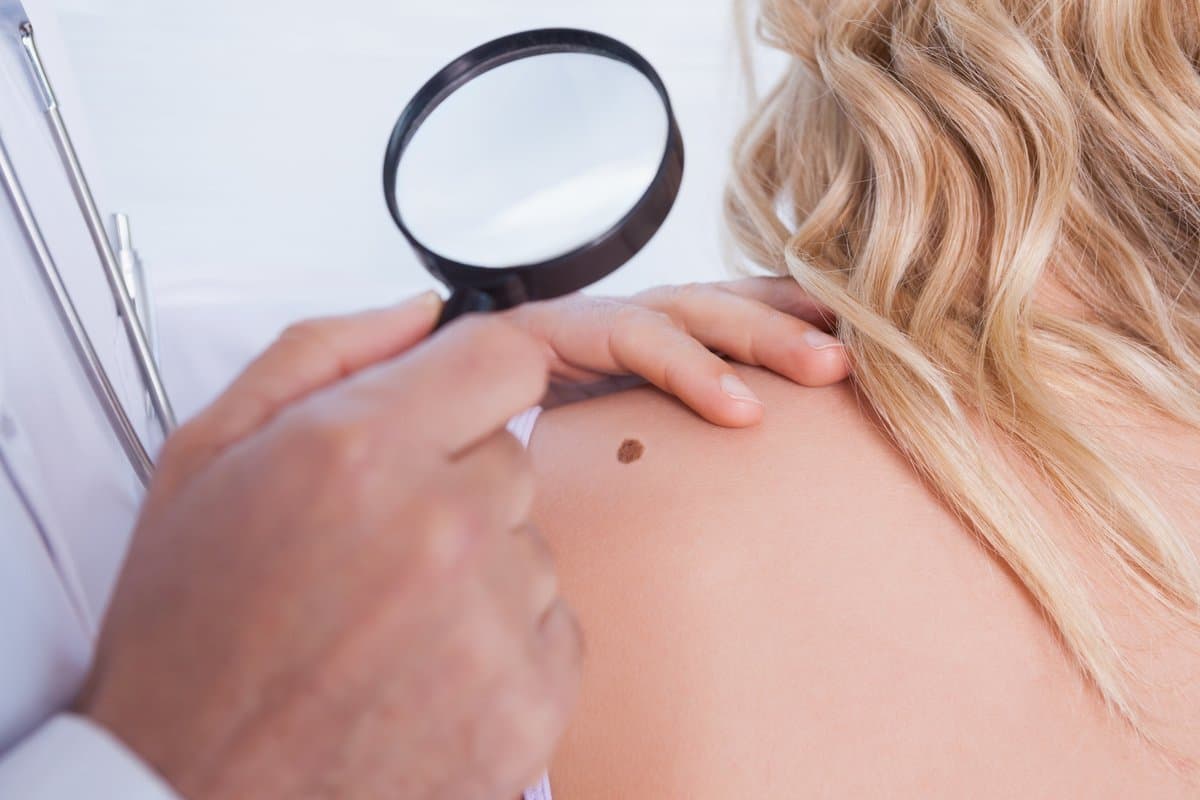 Ang ABCDE Rule para sa Pagsubaybay ng Balat (Gabay para sa mga Nagsisimula)