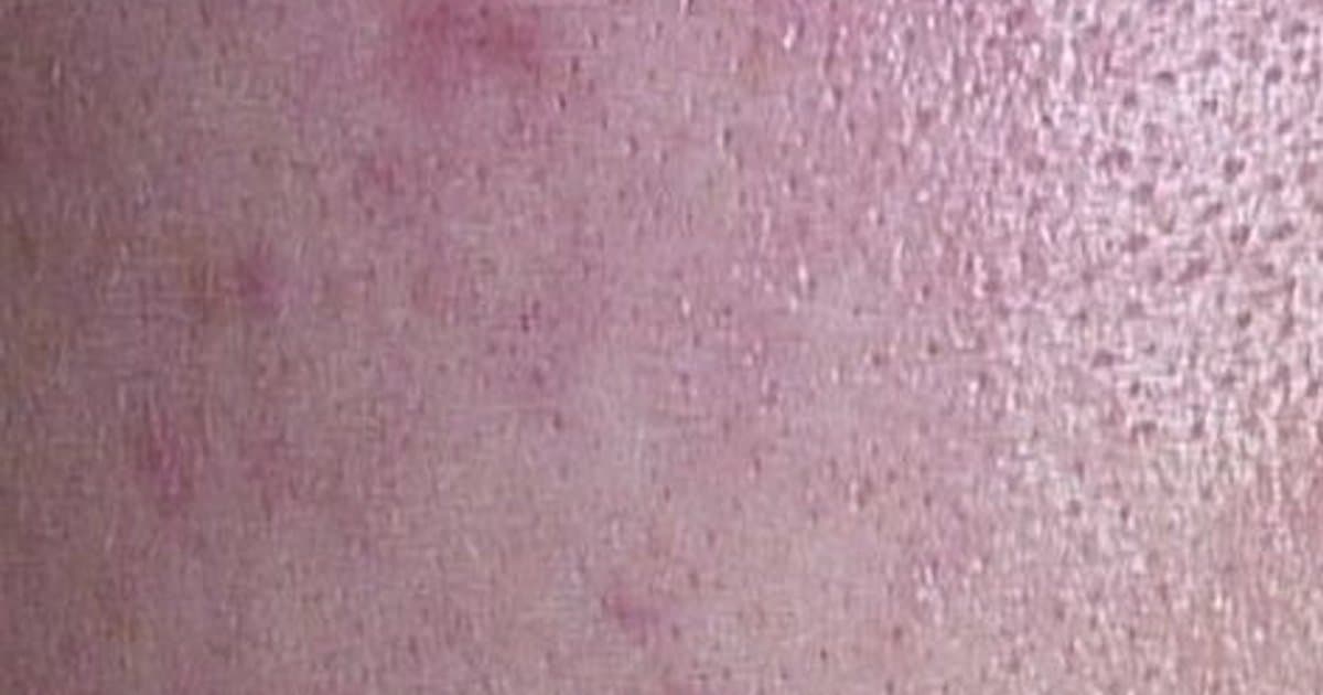 Acne Vulgaris: Ang Kumpletong Gabay sa Pag-unawa at Paggamot ng mga Pumutok