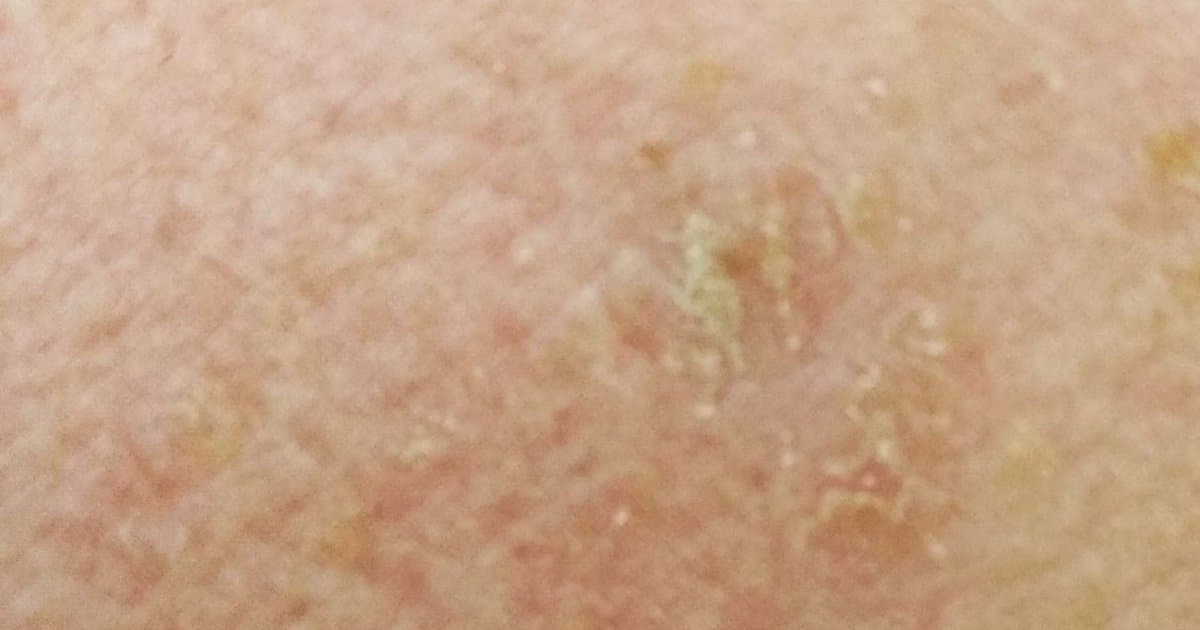 Actinic Keratosis: Ang Babala ng Pre-Cancer na Ipinapadala ng Iyong Balat