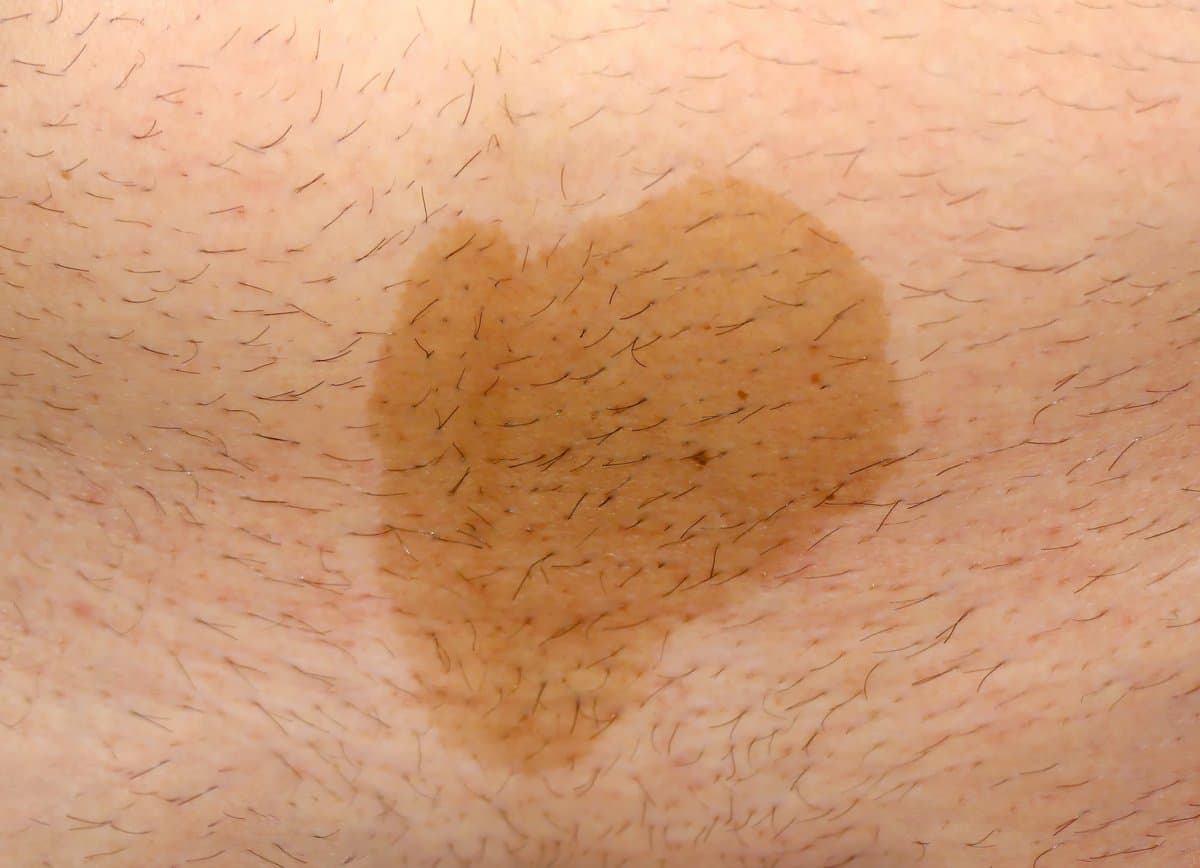 What Is Amelanotic Melanoma?