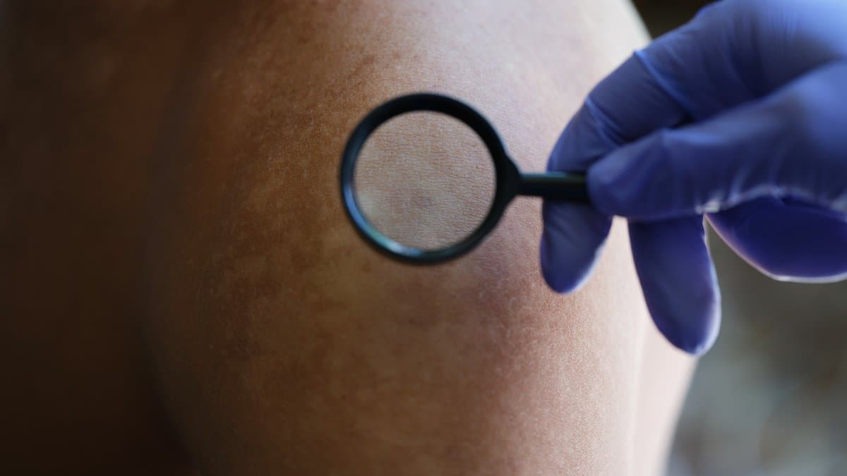 Risk Factors for Amelanotic Melanoma