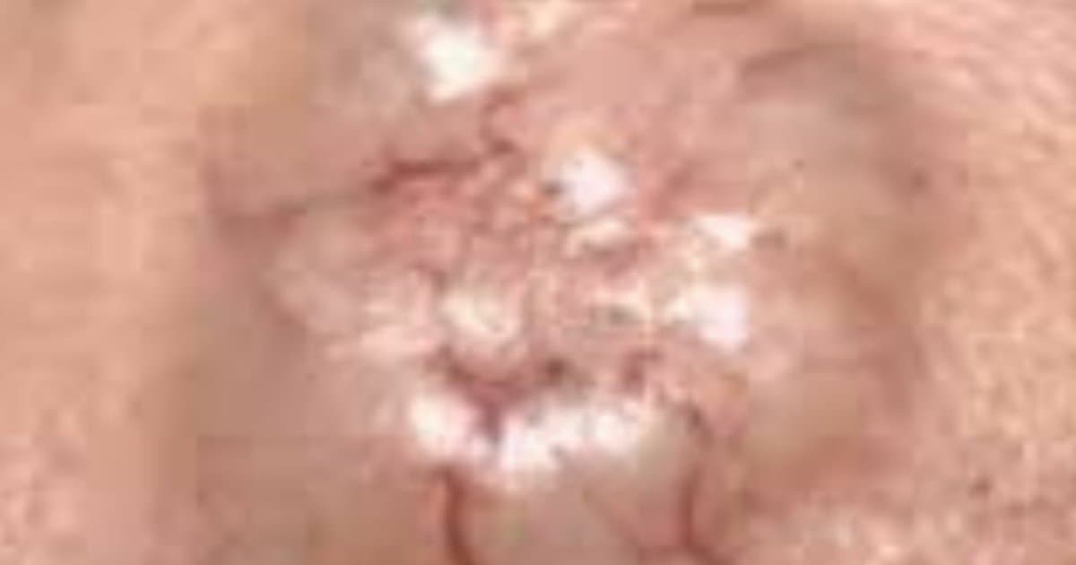 Basal Cell Carcinoma: Ang 'Mabuting' Kanser na Nawasak pa rin ang mga Mukha