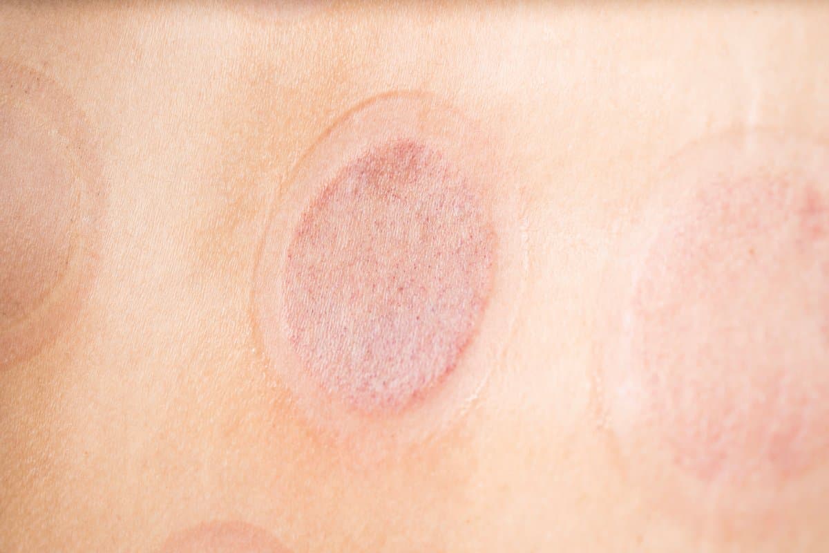 What Is Bowen's Disease?