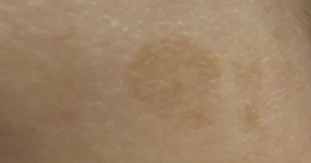 Cherry Angioma: Bakit Ka Patuloy na Nagkakaroon ng Maliit na Pula na Tuldok sa Iyong Balat