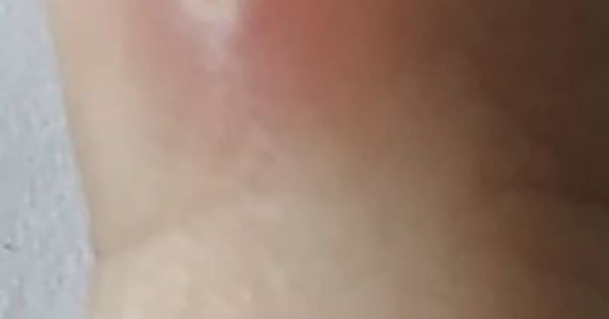 Karaniwang Warts: Ang Matitigas na Tumutubo sa Balat na Patuloy na Bumabalik