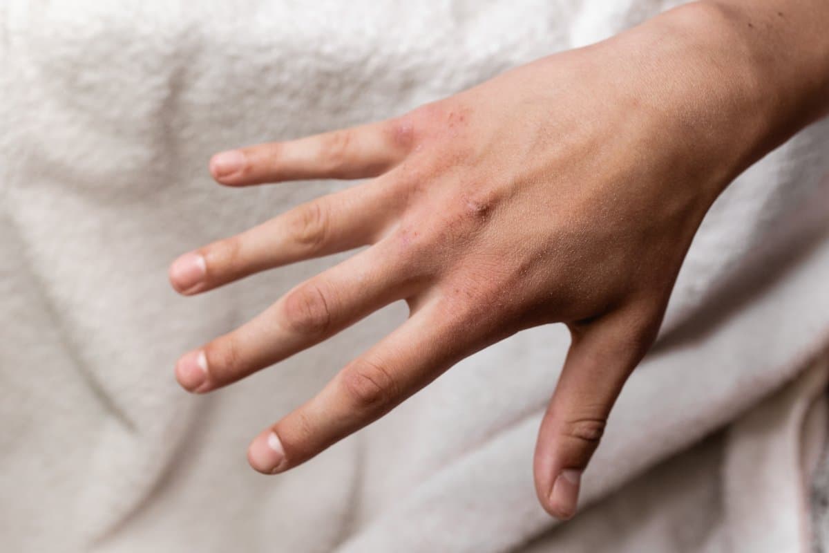 Mga Age Spot vs Kanser sa Balat: Paano Malalaman ang Pagkakaiba