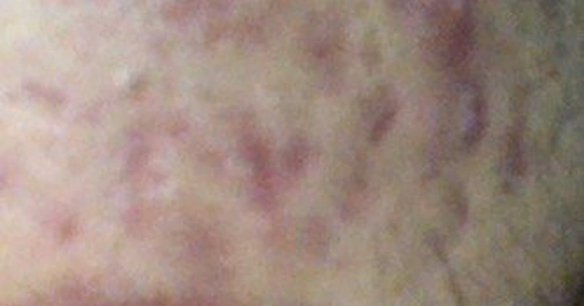 Cystic Acne: Mga Sanhi, Paggamot, at Pag-iwas sa Scars