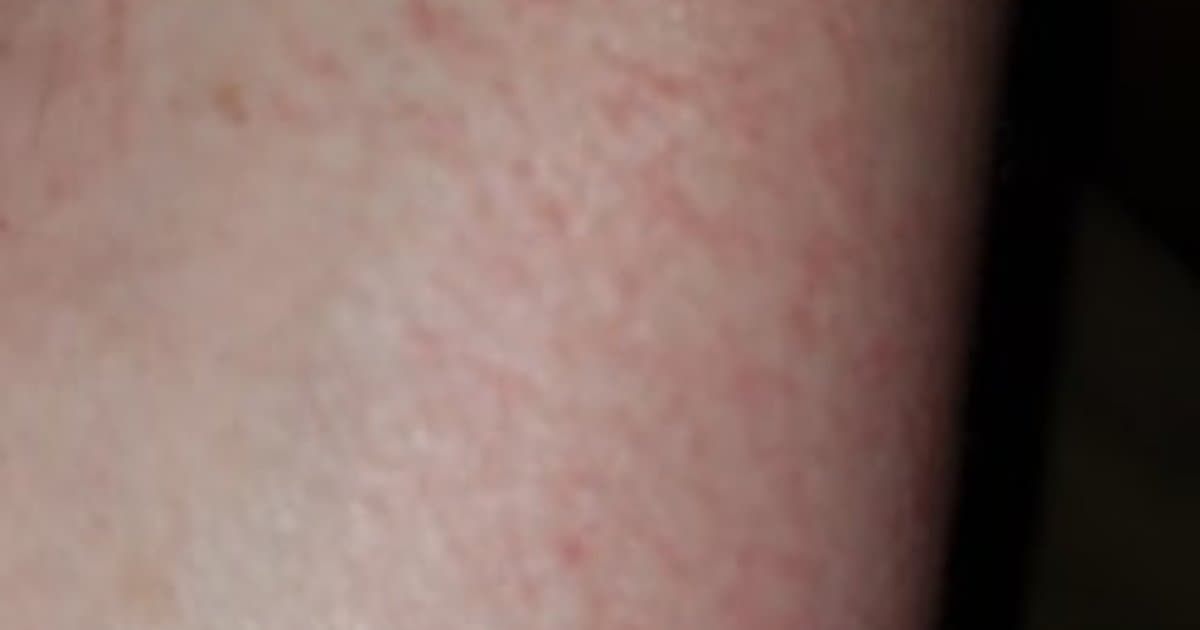 Contact Dermatitis: Kapag ang Iyong Balat ay Tumutugon sa Mundo sa Iyong Paligid