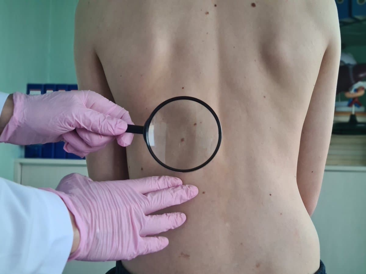 How Dysplastic Nevi Differ from Normal Moles