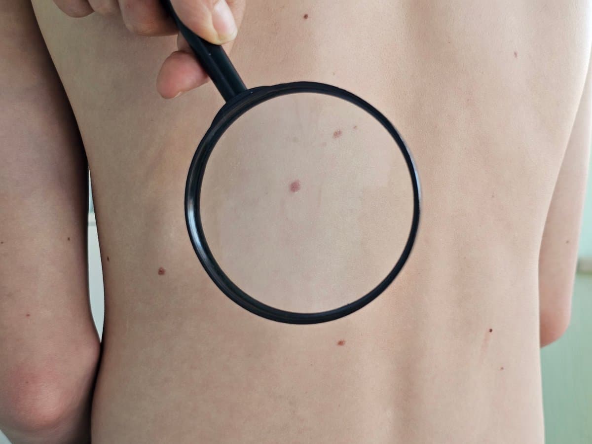 Dysplastic Nevi and Melanoma Risk