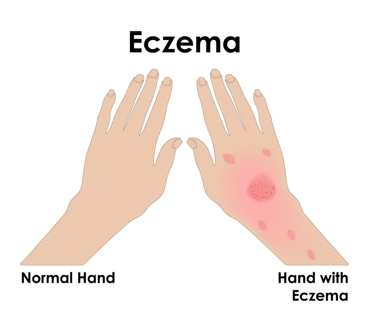 Mga Uri ng Eczema: Hindi Lahat ay Parehong Kondisyon