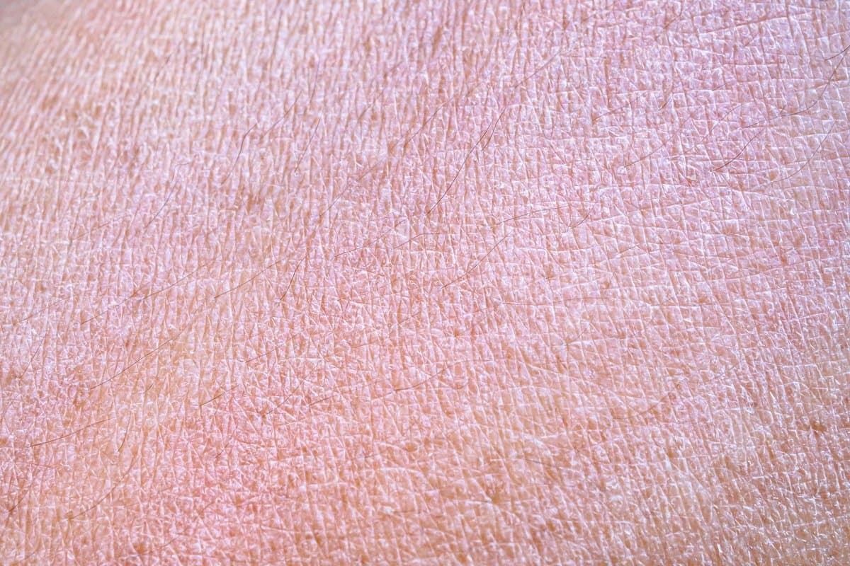 Sobrang Tuyong Balat: 10 Sanhi Higit Pa sa Malamig na Panahon