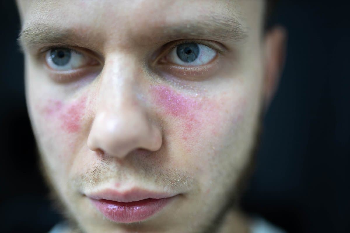 Rosacea: The Most Common Culprit
