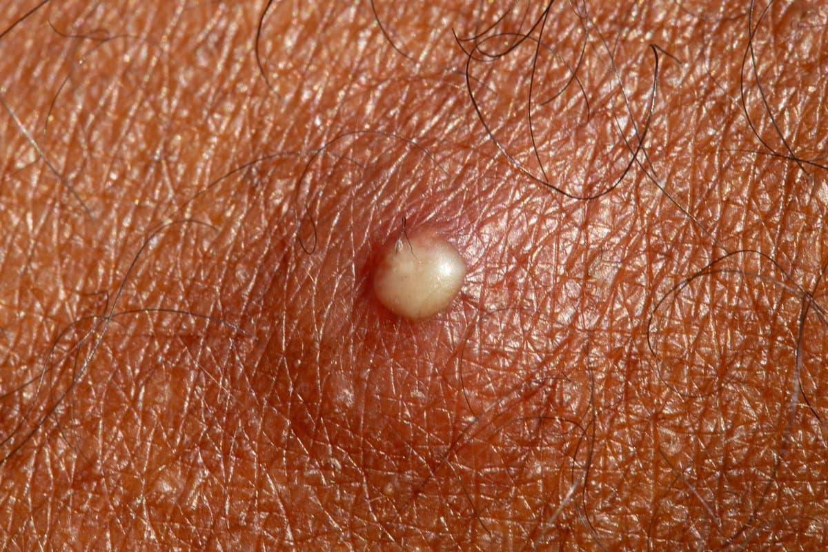 Nasirang Balat ng Araw: Mga Senyales, Pag-iwas at Paano Ito Ayusin