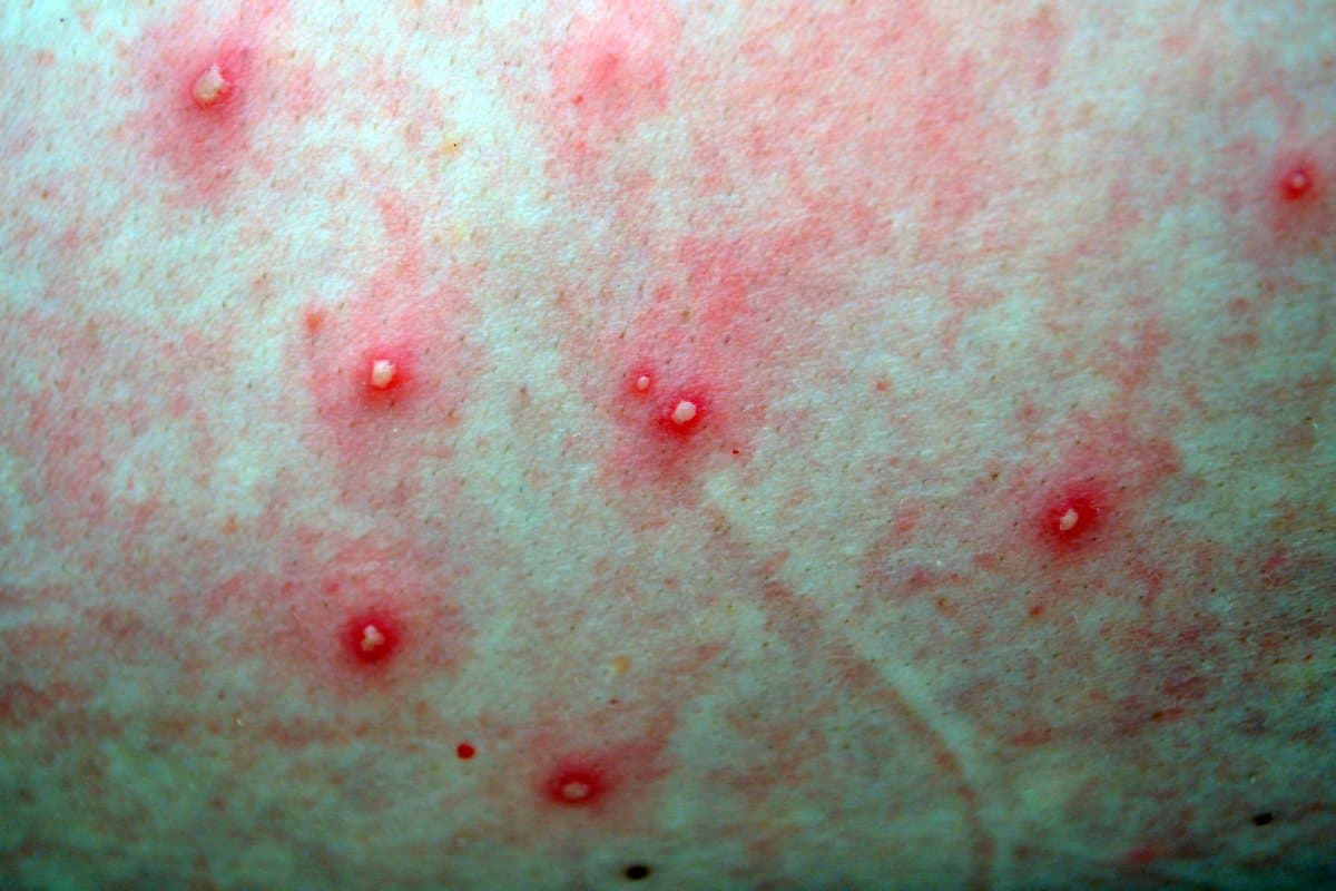What Is Folliculitis?