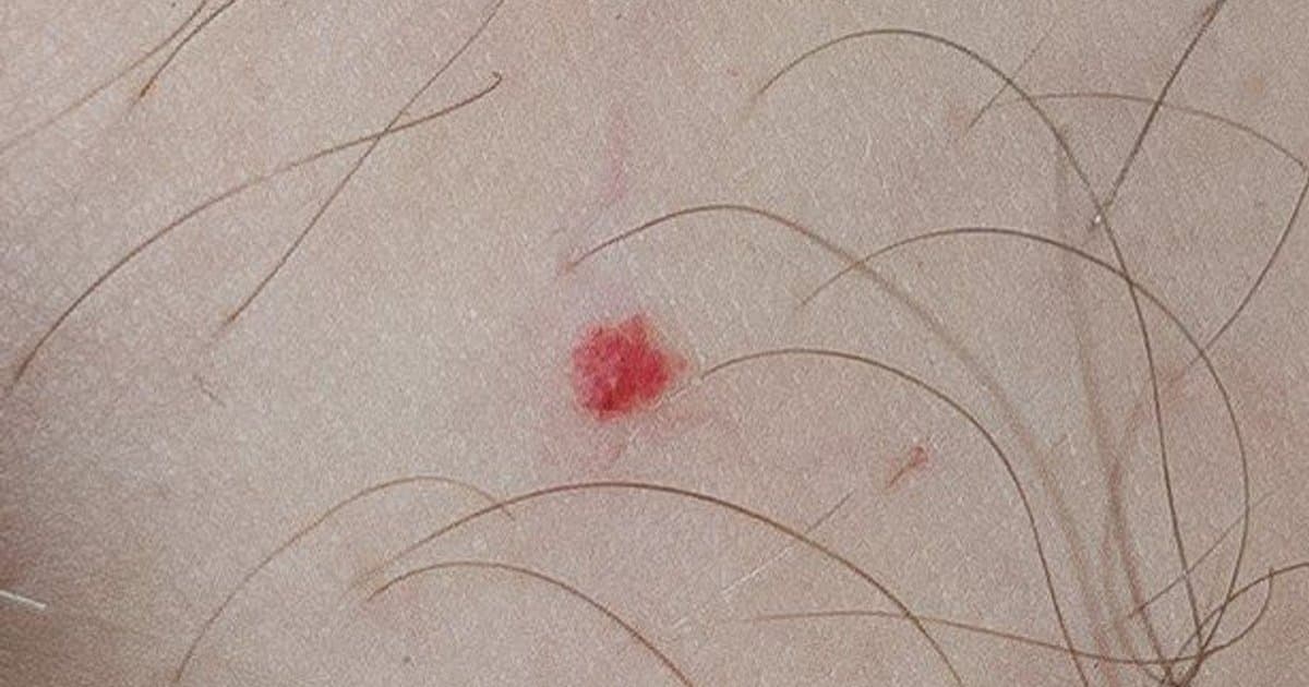 Hemangioma: Pag-unawa sa Vascular Birthmarks sa mga Sanggol