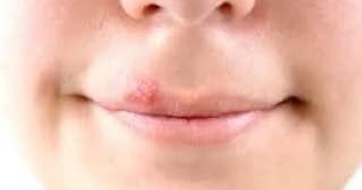 Herpes Simplex: Paghihiwalay ng Medikal na Katotohanan mula sa Sosyal na Stigma