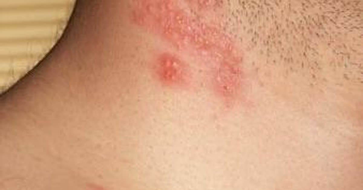 Shingles (Herpes Zoster): Mga Sanhi, Sintomas, at Paggamot