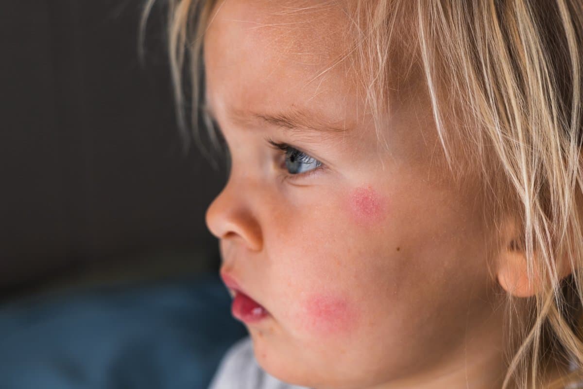 What Is Impetigo?