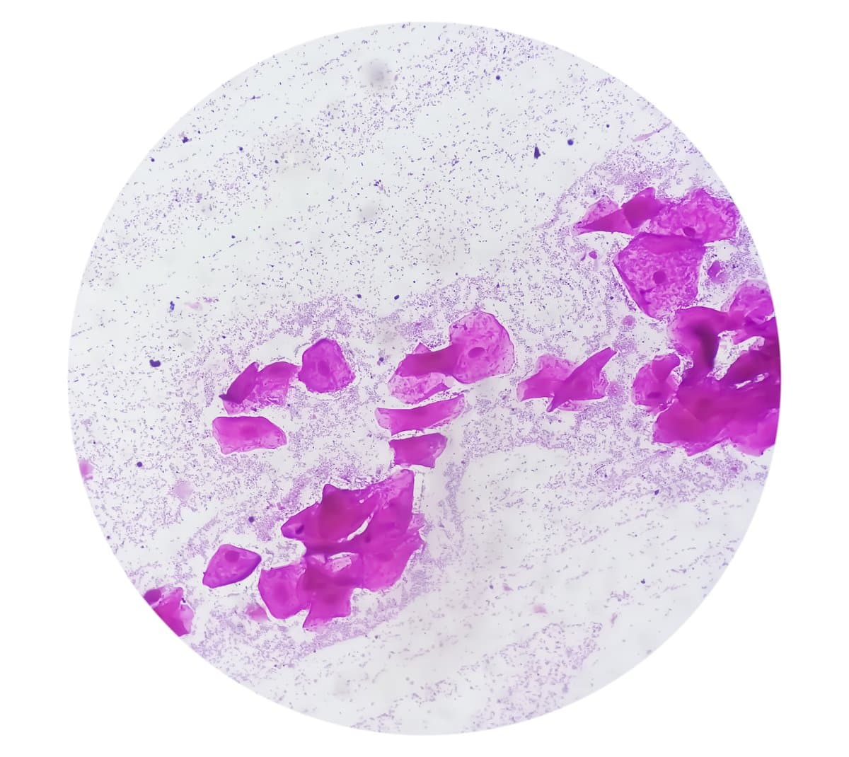 Causes: Staphylococcus and Streptococcus