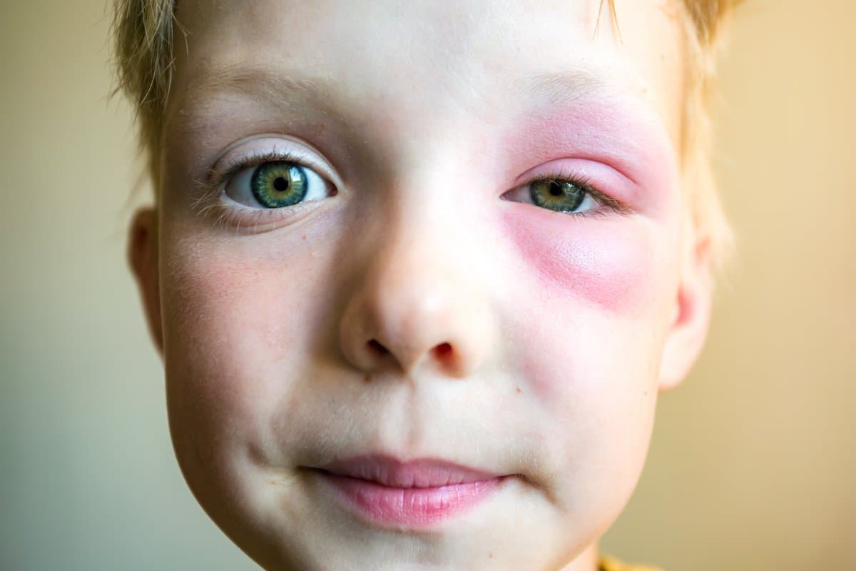 Impetigo: Isang Gabay sa Karaniwang Impeksyon sa Balat ng mga Bata