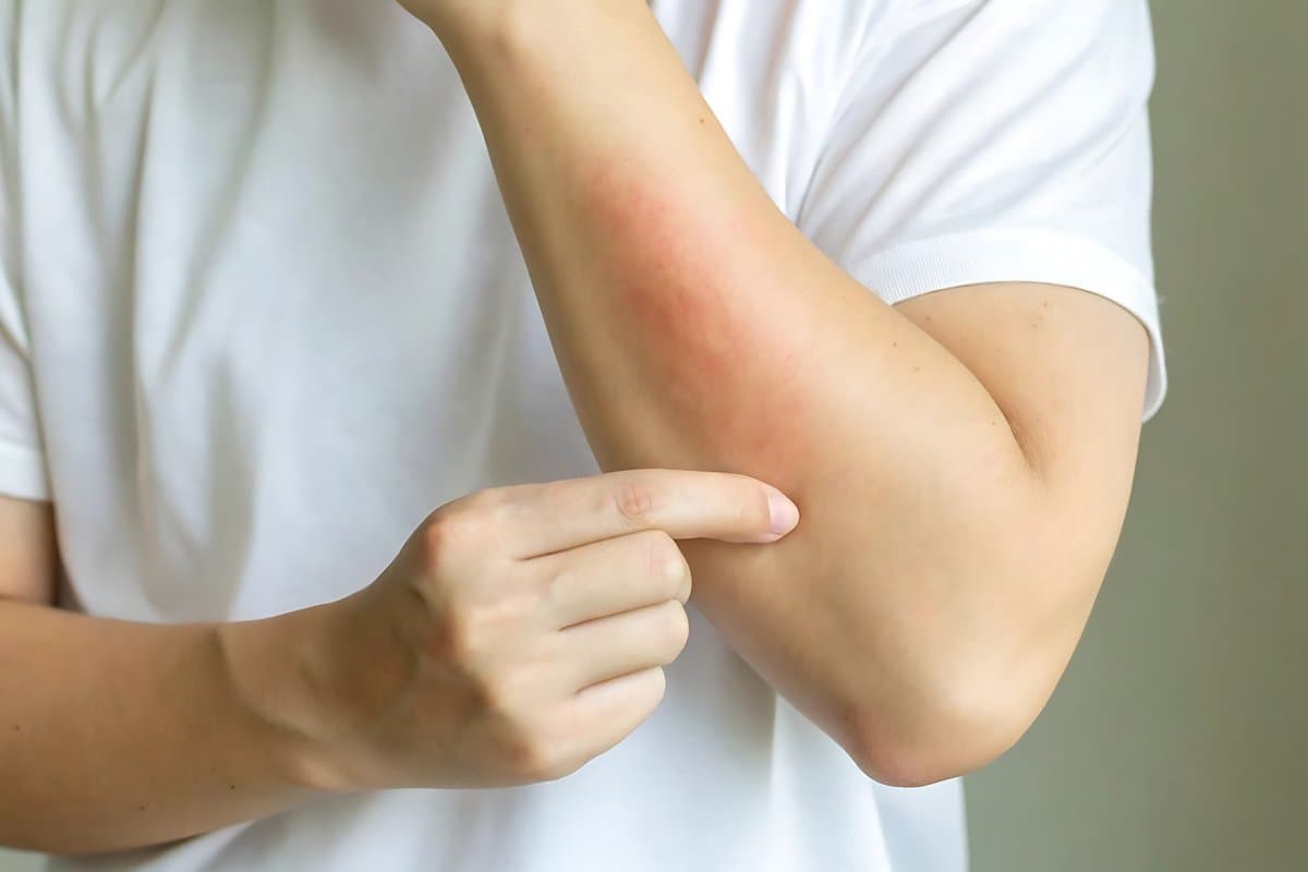 Makating Pantal na Patuloy na Bumabalik: Ano ang Sinasabi ng Iyong Balat