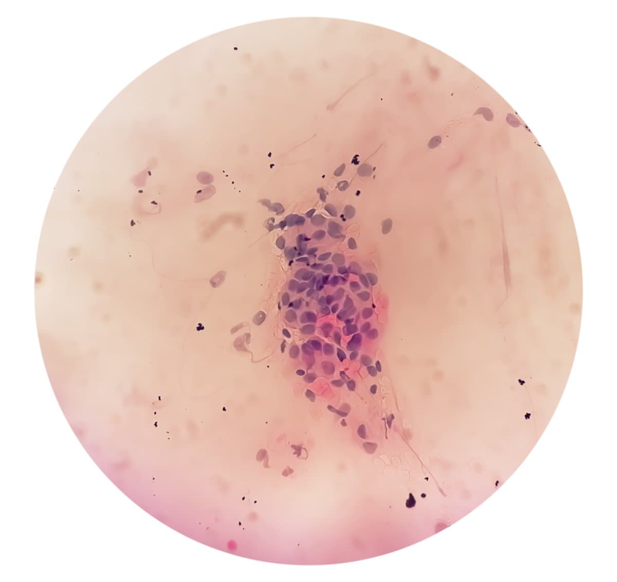 Keratoacanthoma vs. Squamous Cell Carcinoma