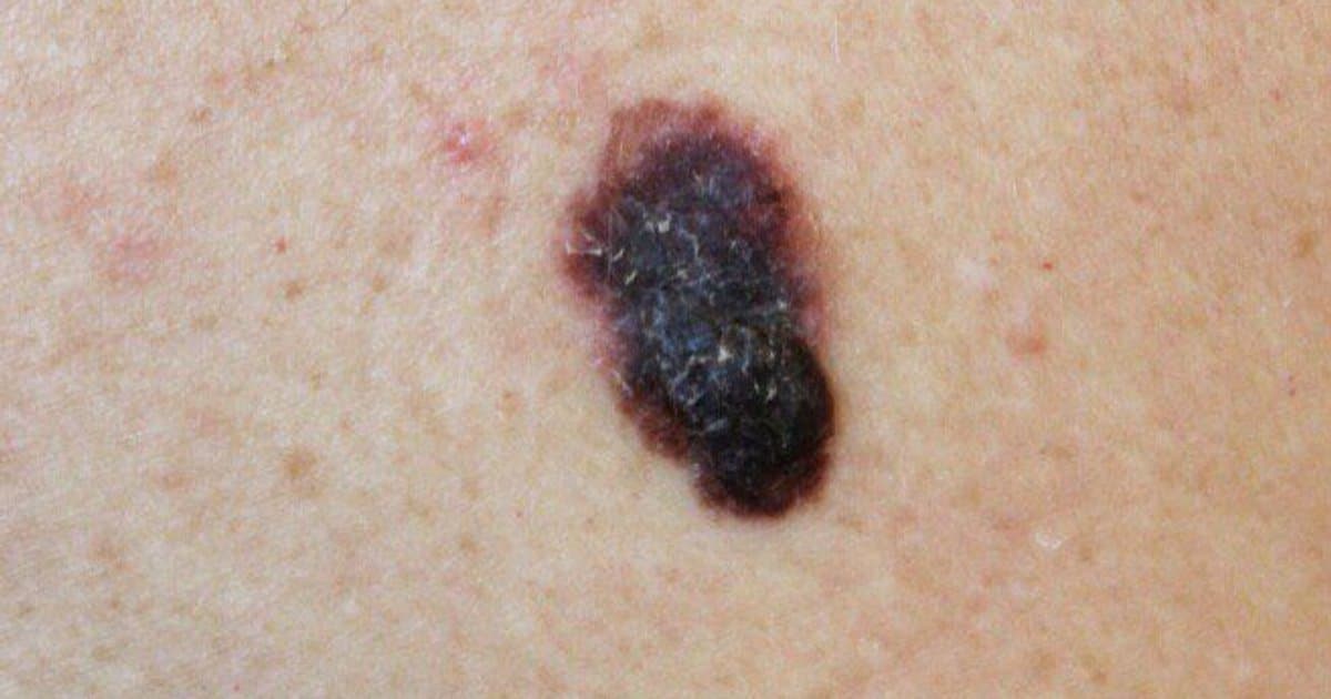 Melanoma: Ang Pinakamamatay na Kanser sa Balat na Dapat Mong Malaman