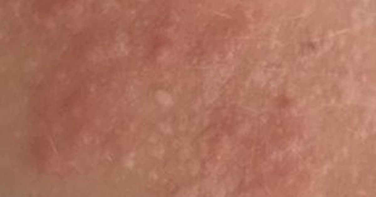 Milia: Pag-unawa sa Maliit na Puting Cysts sa Ilalim ng Iyong Balat