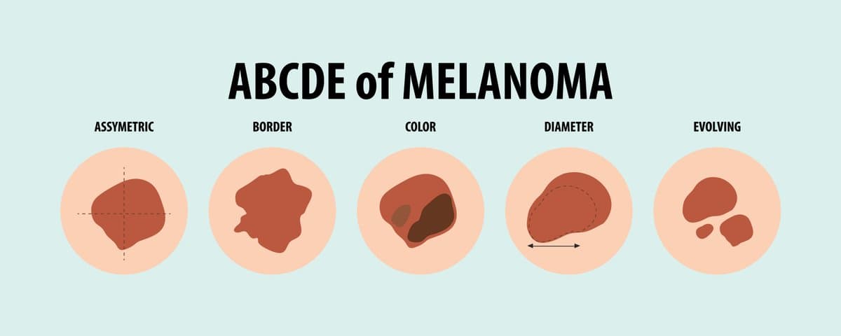 Types of Moles You Should Know