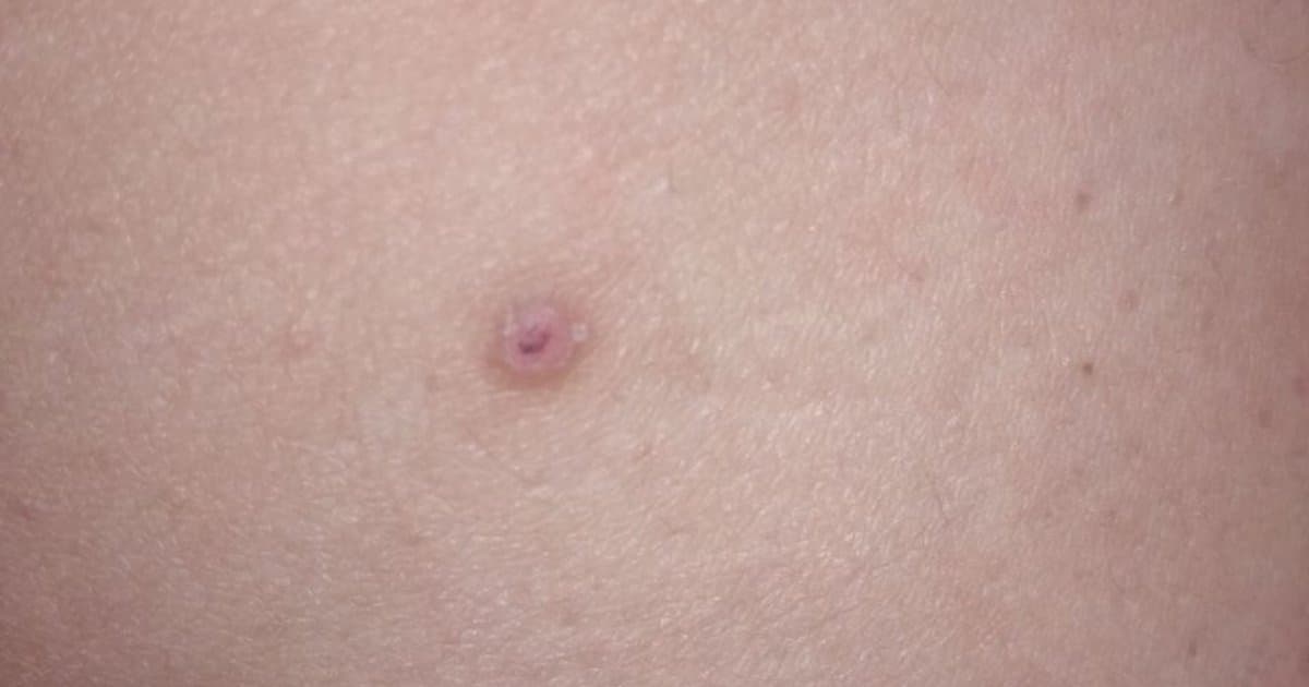 Molluscum Contagiosum: Mga Sanhi, Sintomas, at Paggamot