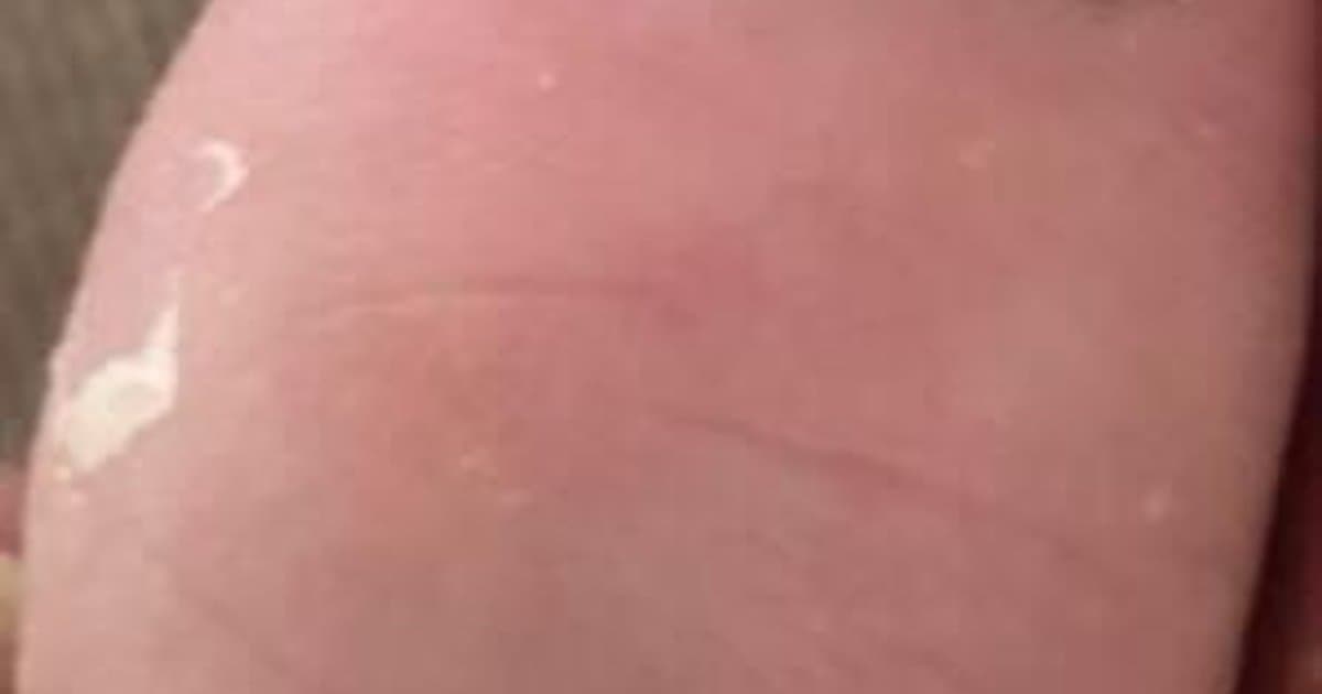 Fungus sa Kuko (Onychomycosis): Ang Patuloy na Impeksyon na Sinusubok ang Iyong Pasensya