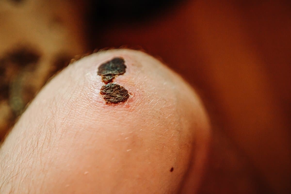 Nodular Melanoma: Ang Pinaka Agresibong Uri ng Kanser sa Balat