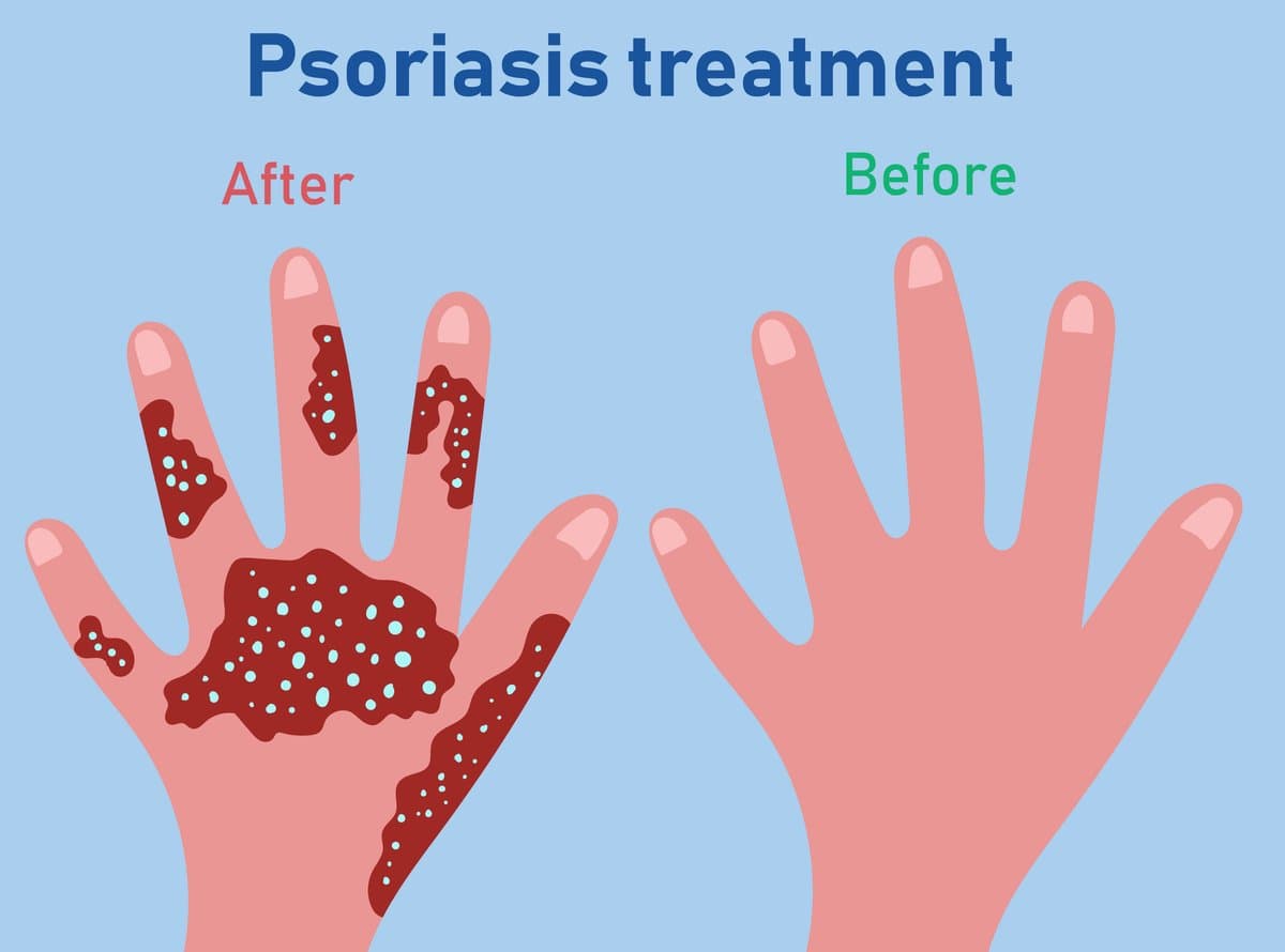 Types of Psoriasis: From Common Plaques to Life-Threatening Forms