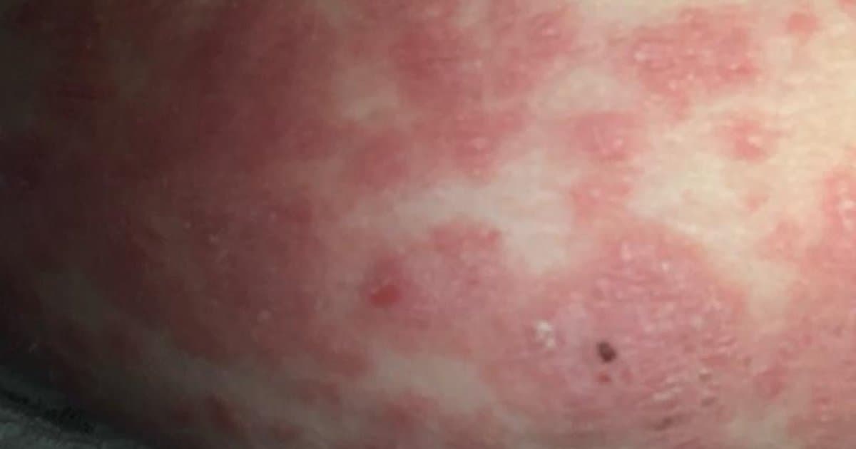 Pustular Psoriasis: Mga Sanhi, Anyong, at Paggamot