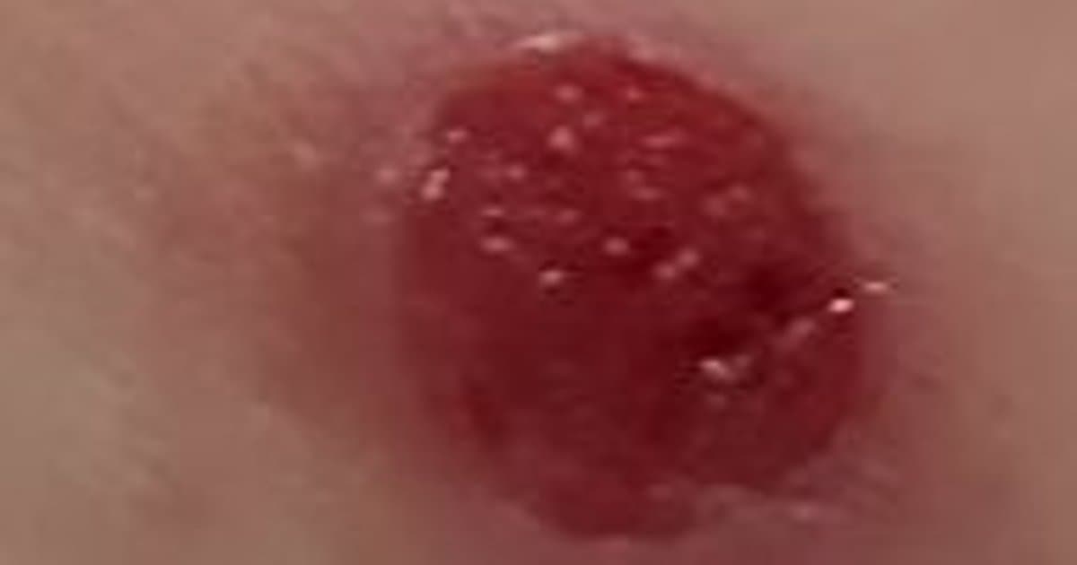 Pyogenic Granuloma: Mga Sanhi, Pagkilala, at Paggamot