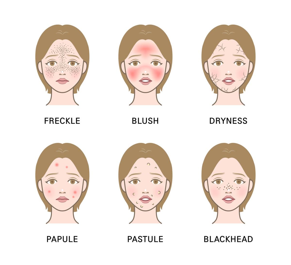 The Four Subtypes of Rosacea: Which One Do You Have?