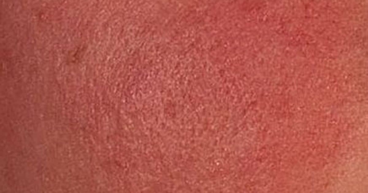Rosacea: Pag-unawa sa Talamak na Pamumula ng Mukha na Akala ng Marami ay Acne