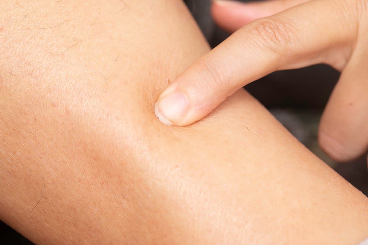 May Flaky na Balat sa Iyong Mukha? Mga Sanhi at Paano Ito Agad na Ayusin