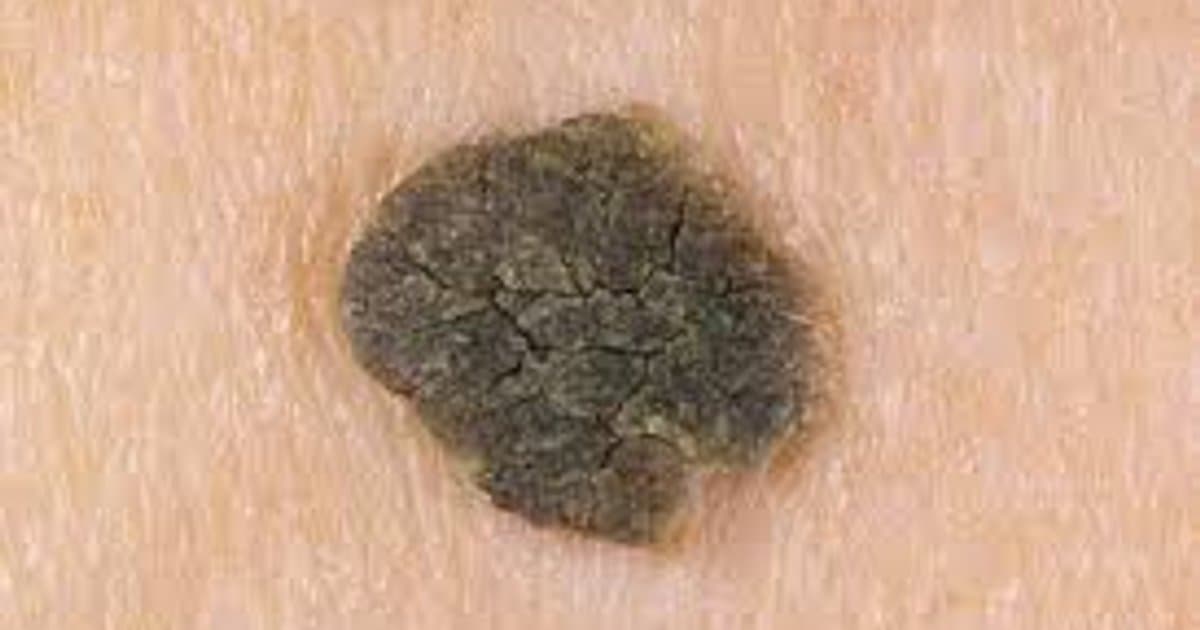 Seborrheic Keratosis: Ang mga Walang Pinsalang Tumutubo na Mukhang Nakababahala na Kanser sa Balat