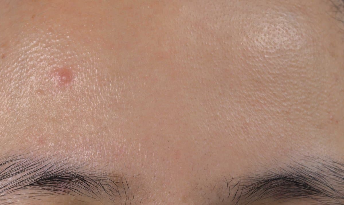 Chemical vs Physical Exfoliation for Texture