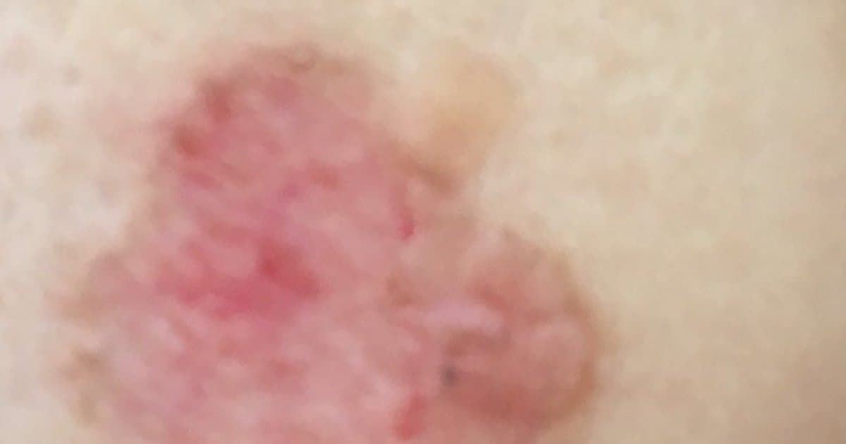 Squamous Cell Carcinoma: Ang Kanser sa Balat na Nangangailangan ng Paggalang