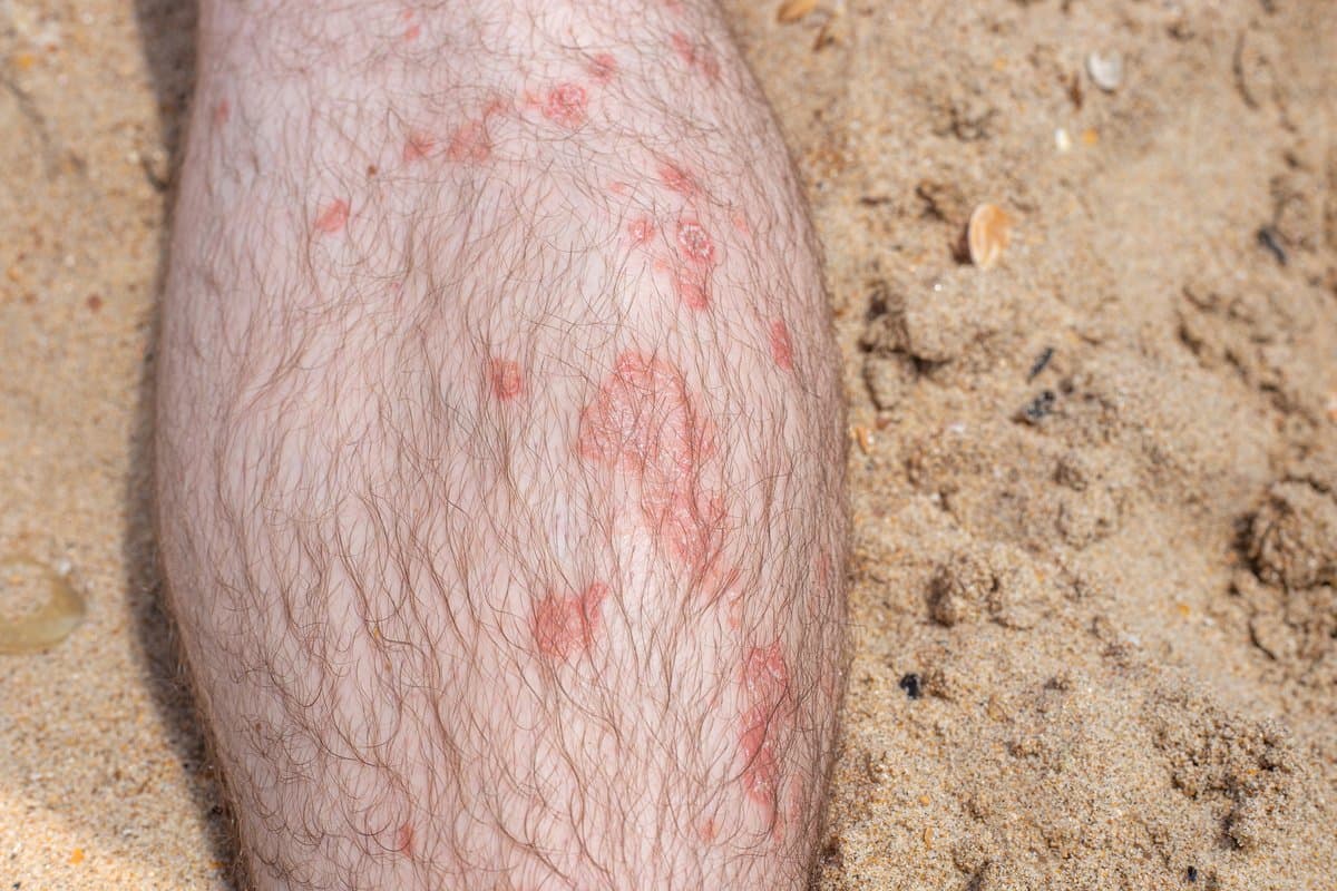 Dandruff vs Dry Scalp: Hindi Sila Pareho