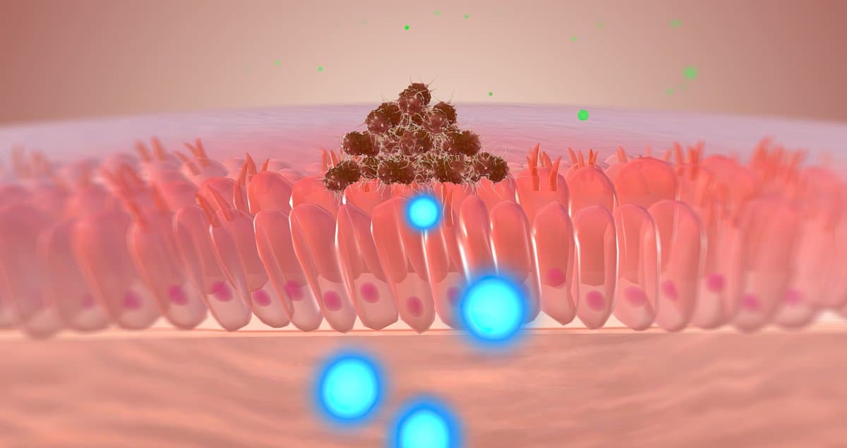 How Superficial Spreading Melanoma Develops