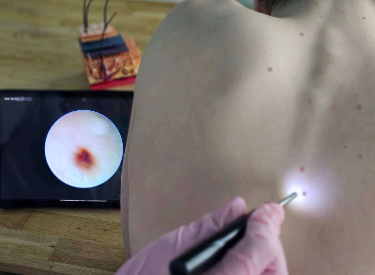 The ABCDE Rule for Detection