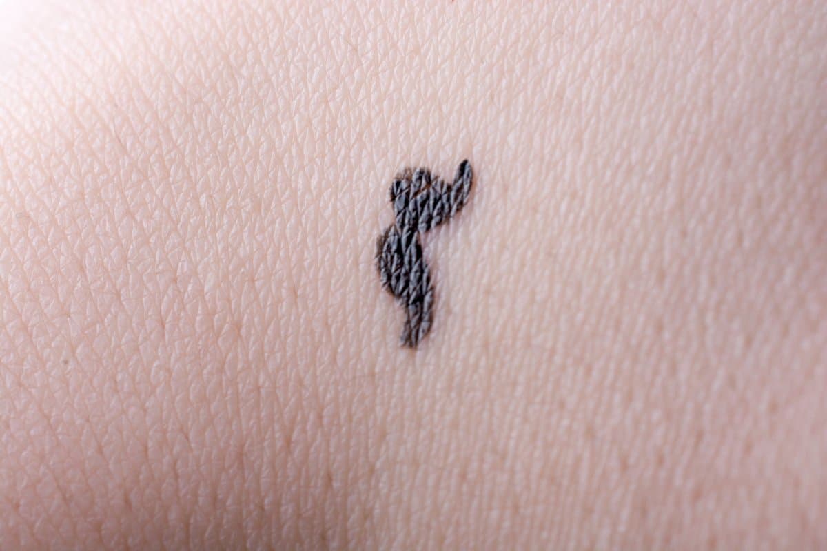 Superficial Spreading Melanoma: Ang Pinakakaraniwang Uri ng Melanoma