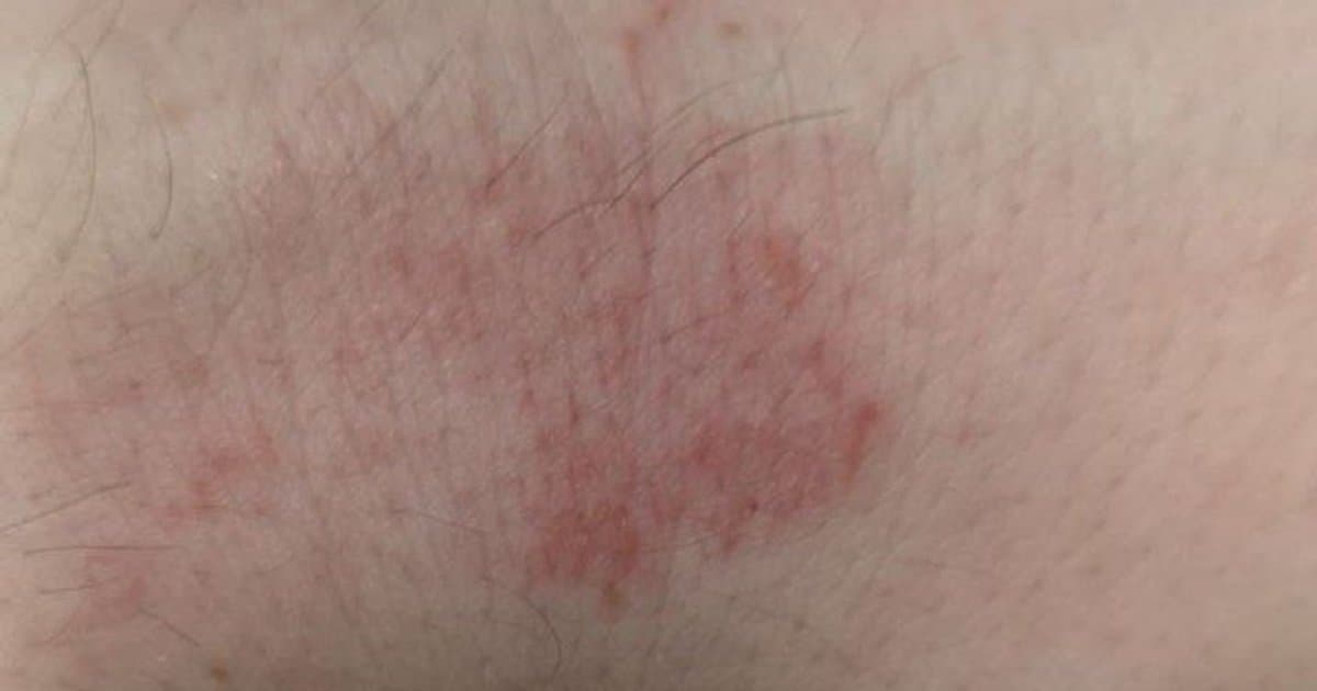 Urticaria (Mga Pantal): Kapag Ang Iyong Balat Ay Sumabog Nang Walang Babala