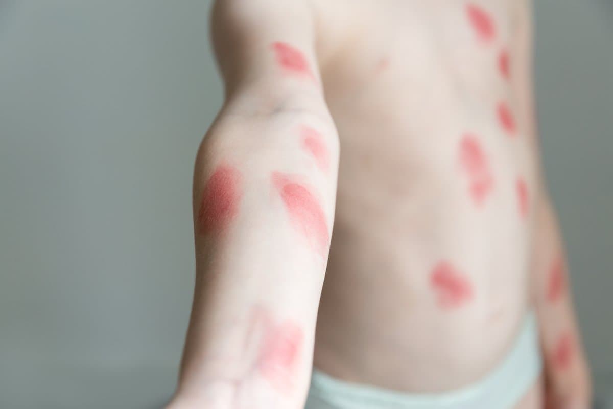 Symptoms and the Stages of the Rash