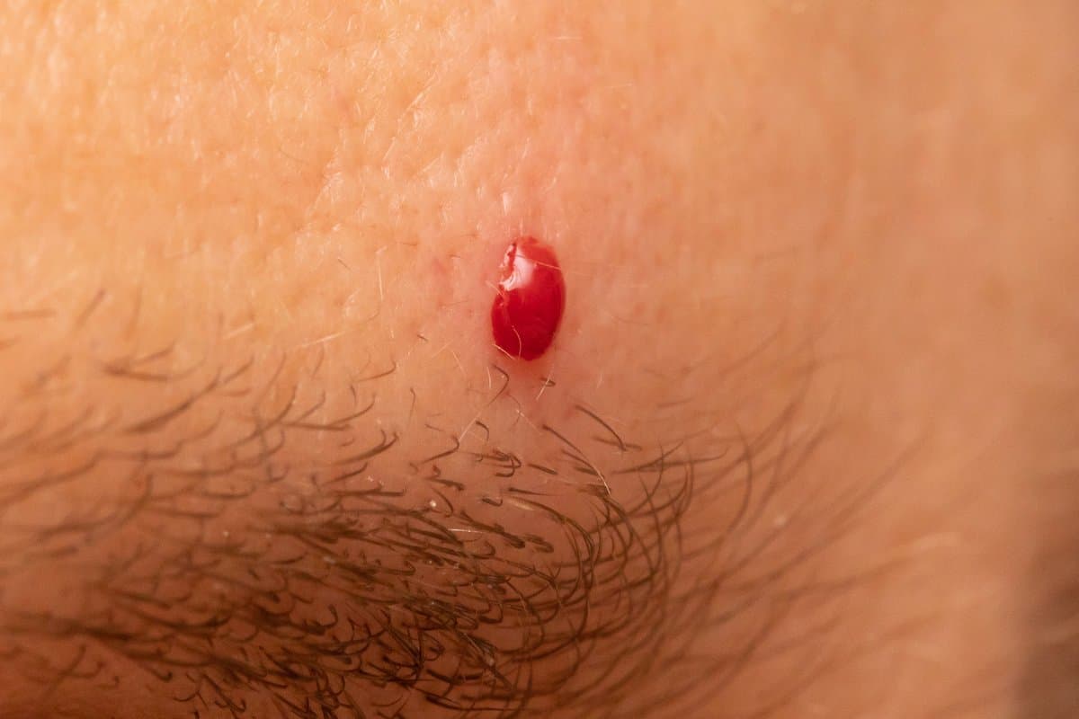 What Is Merkel Cell Carcinoma?