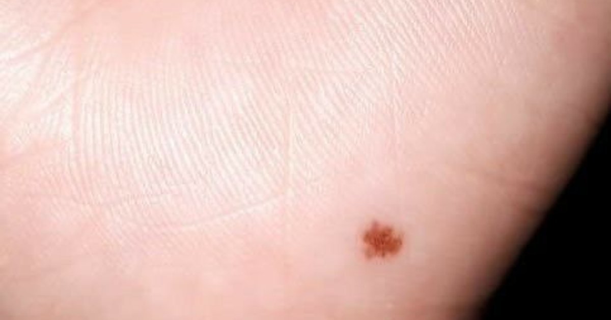 Acral Nevus: Moles on Palms, Soles & Nails — Normal Patterns vs. Acral ...